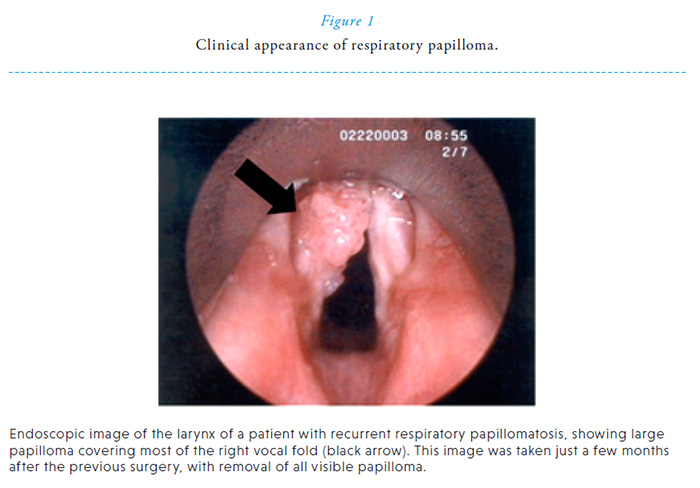 laryngeal respiratory papillomatosis)