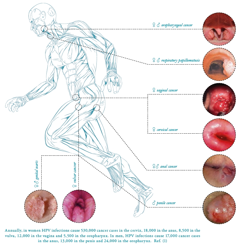 Hpv that causes warts cause cancer, Hpv genital warts cause cancer